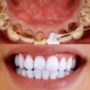 علاج ازالة بقع الاسنان السوداء